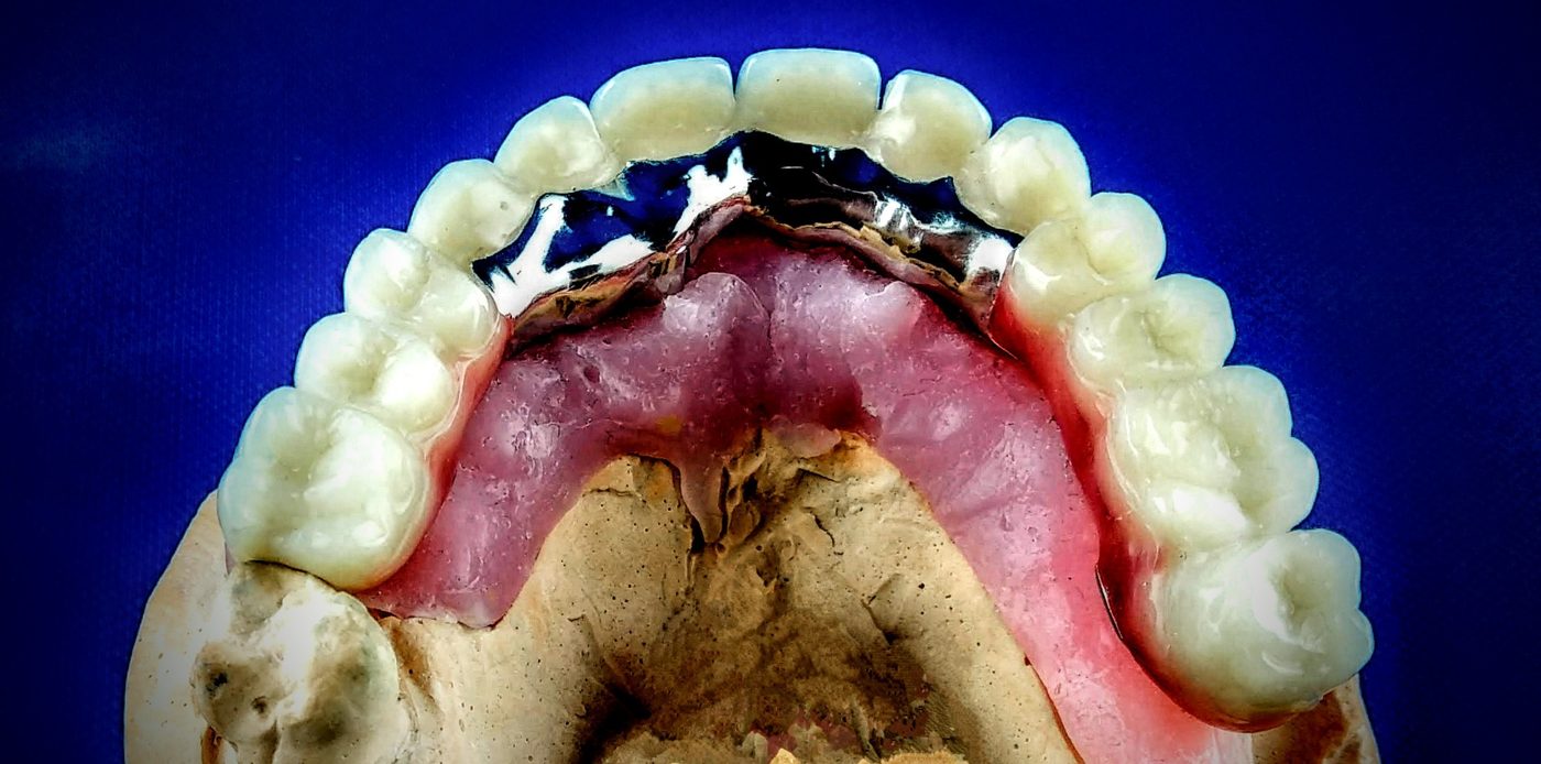 Vue occlusale — prothèse complète sur barre