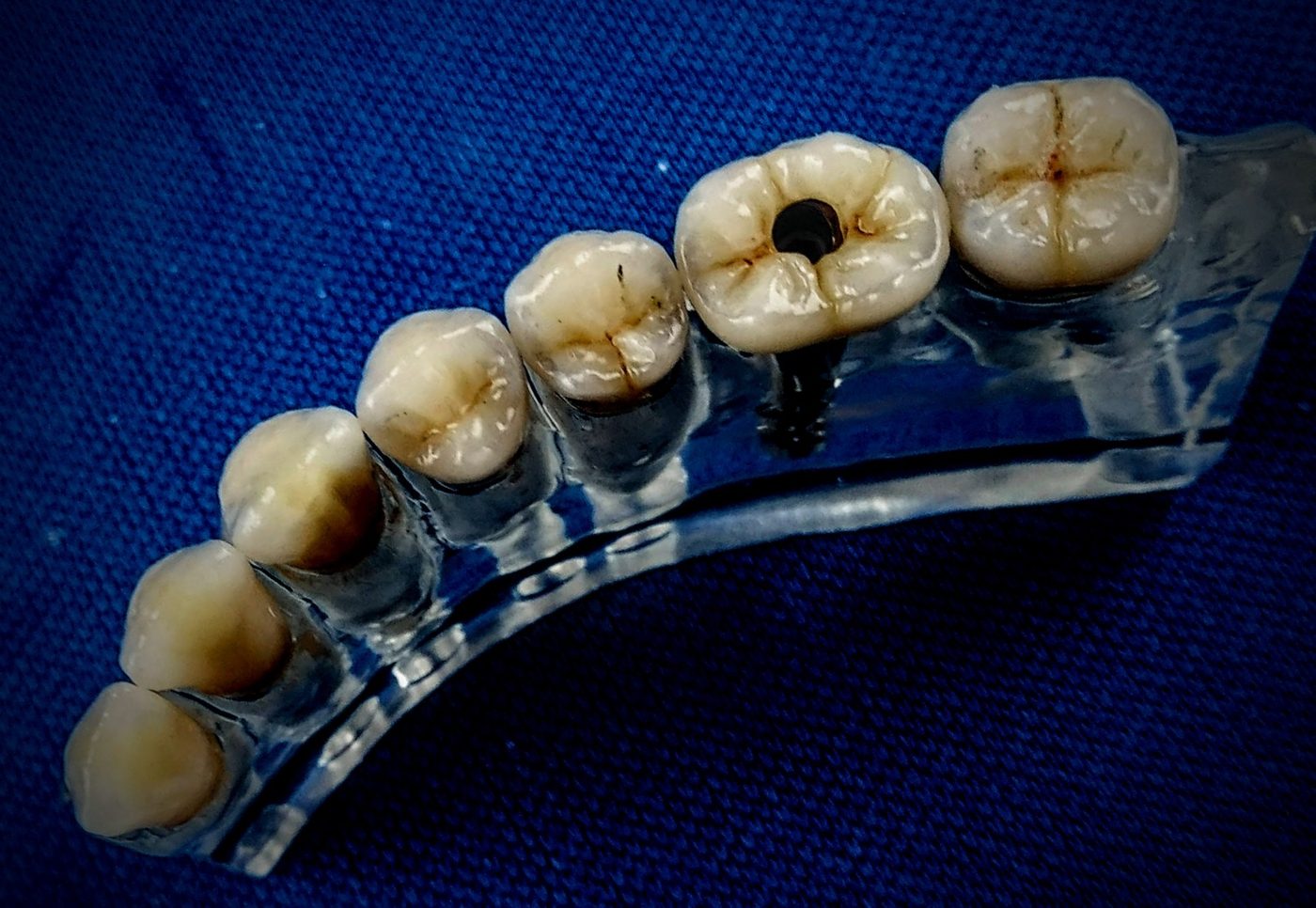 Reconstitution sur socle — détail occlusal