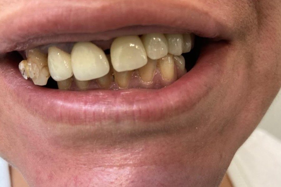 Situation initiale : dentition usée, ligne du sourire effondrée