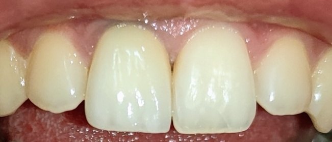 Après : céramique stratifiée sur zircone, intégrée aux dents naturelles